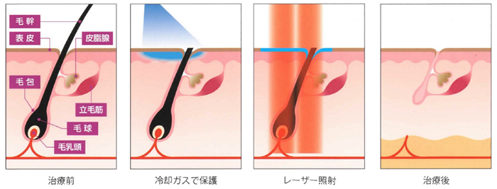 ジェントルレーズ プロの施術の流れ