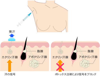 多汗症の改善